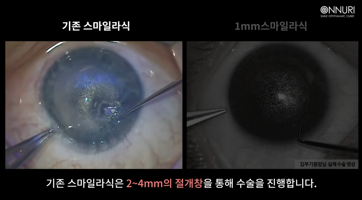 실제 비교영상! 1mm스마일라식은 어떻게 다를까?