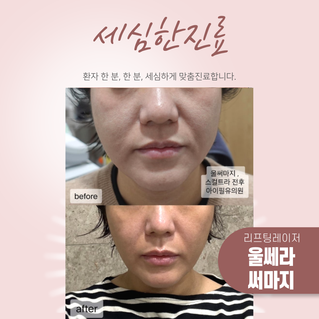 울쎄라,써마지,덴서티 장비