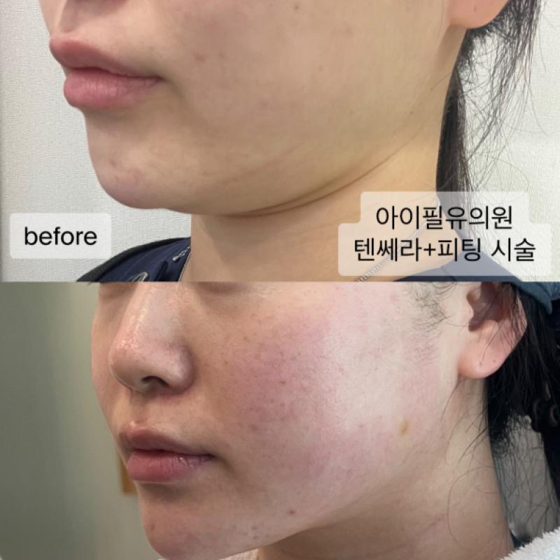 텐쎄라 600라인+피팅리프팅 6만줄