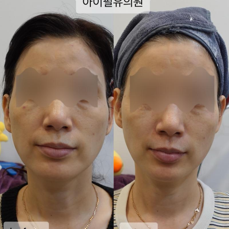 텐쎄라 +써마지 1달 후