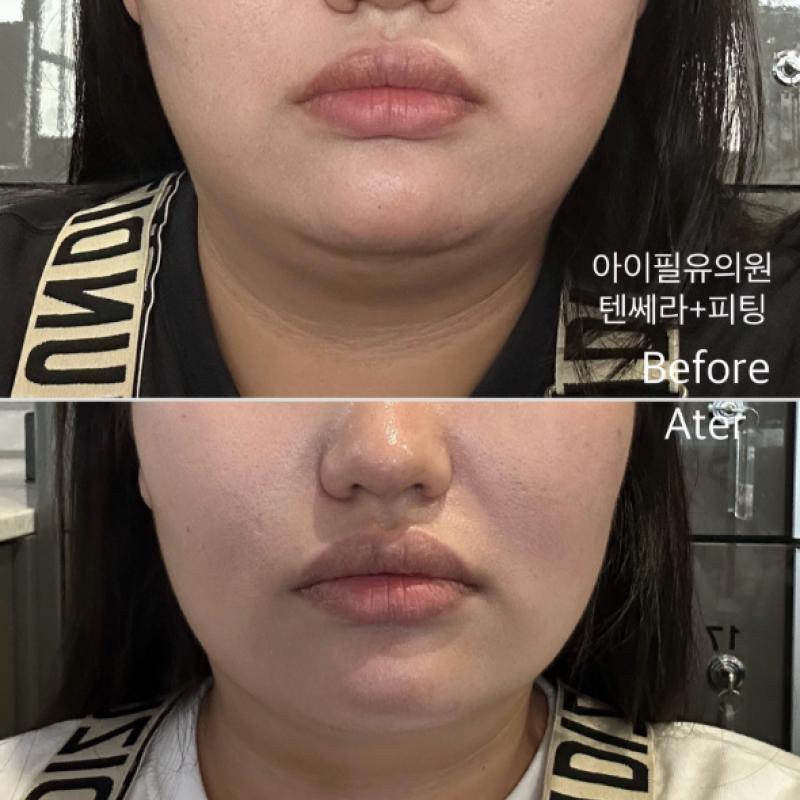 텐쎄라+피팅레이저