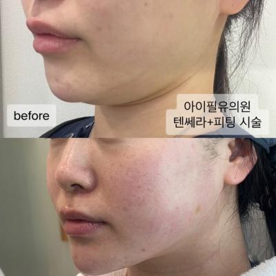 텐쎄라 리프팅 강남역 아이필유의원